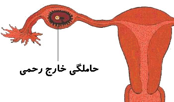 بارداری خارج از رحم